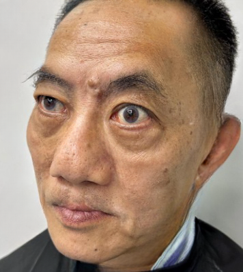 去眼袋手术