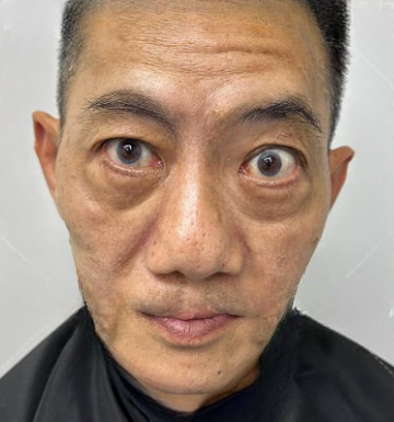 去眼袋手术