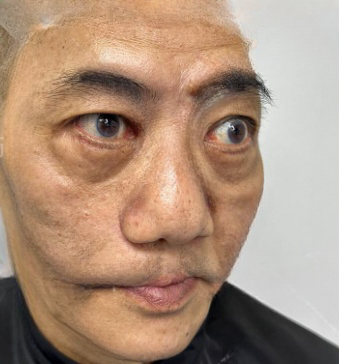 去眼袋手术