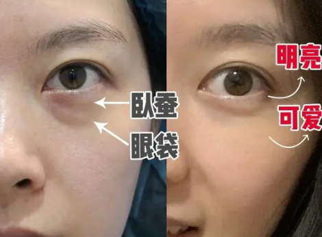 去眼袋手术