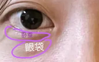去眼袋手术
