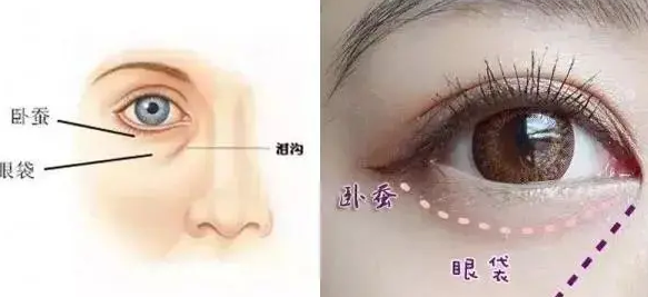 去眼袋手术
