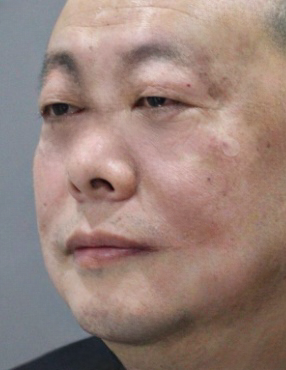 去眼袋手术