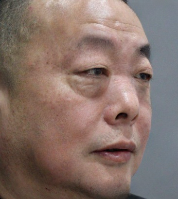 去眼袋手术