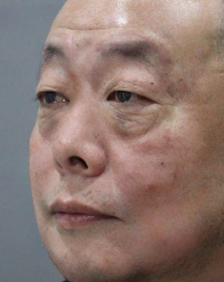 去眼袋手术