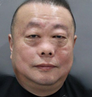 去眼袋手术