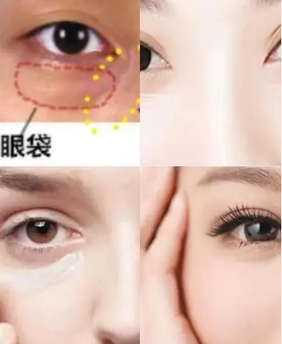 眼袋