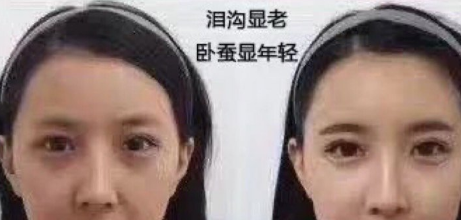 眼袋