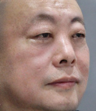 去眼袋手术