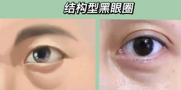 眼袋