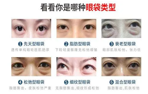 眼袋