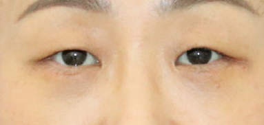 眼袋