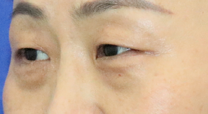 眼袋
