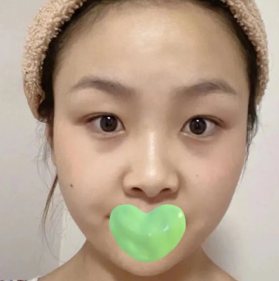 眼袋