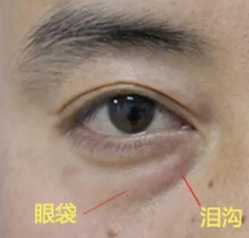 眼袋