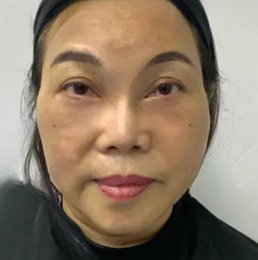 去眼袋手术