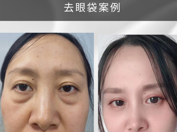 去眼袋手术