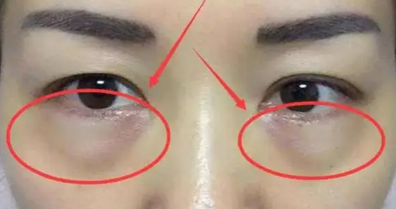 去眼袋手术