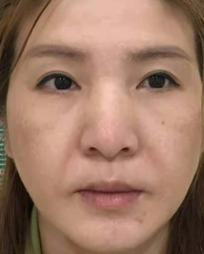 去眼袋手术