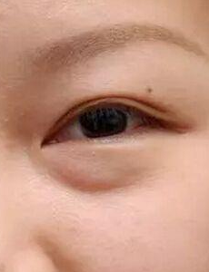 眼袋