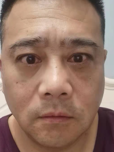 眼袋