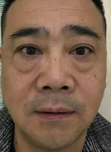 眼袋