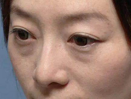 去眼袋手术