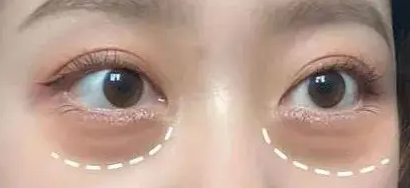 去眼袋手术