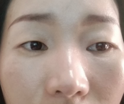 去眼袋手术