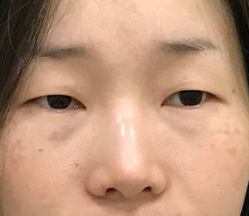 去眼袋手术