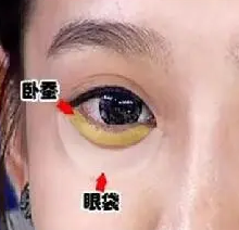 去眼袋手术