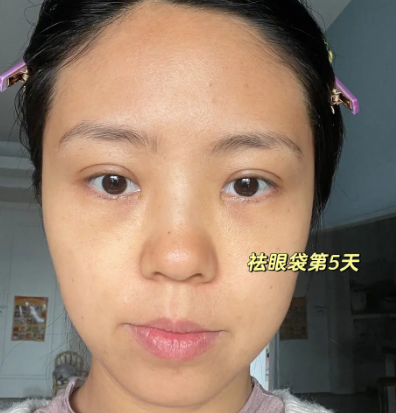 去眼袋手术