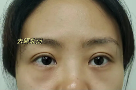 去眼袋手术