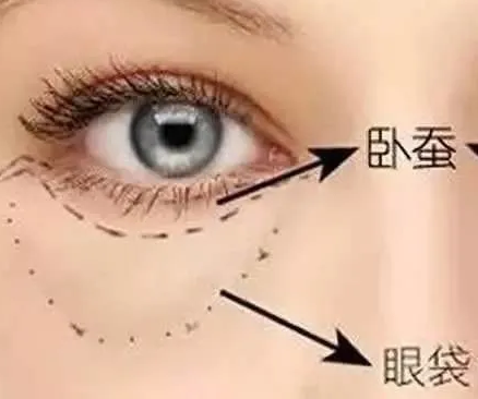 去眼袋手术