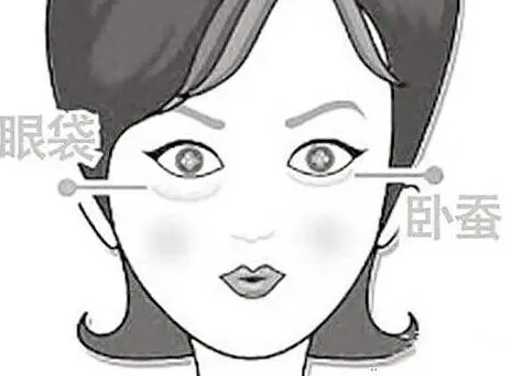 去眼袋手术