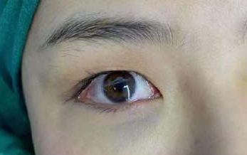 去眼袋手术