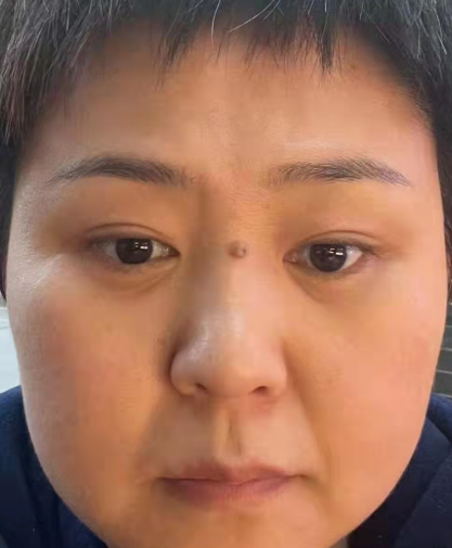 去眼袋手术