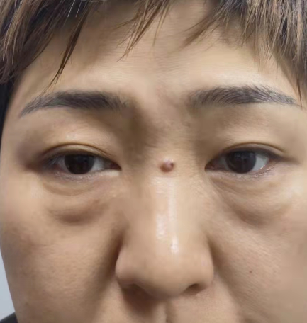去眼袋手术