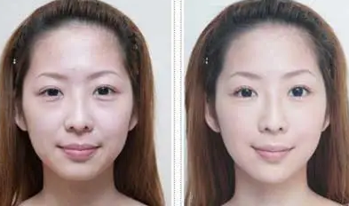 去眼袋手术