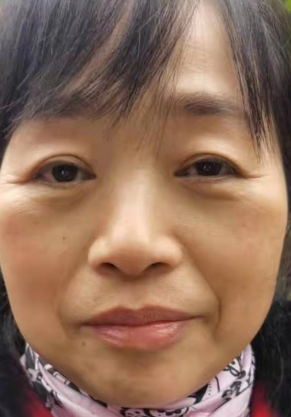 去眼袋手术