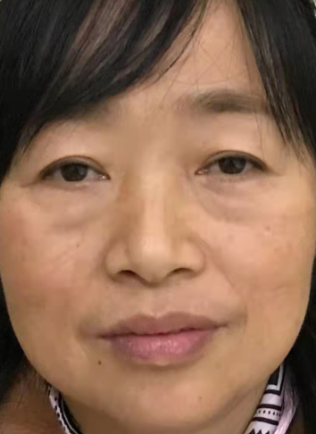 去眼袋手术