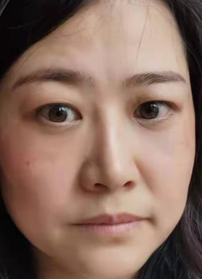 去眼袋手术
