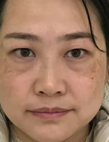 去眼袋手术