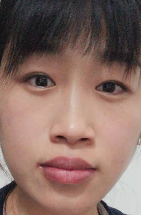 去眼袋手术