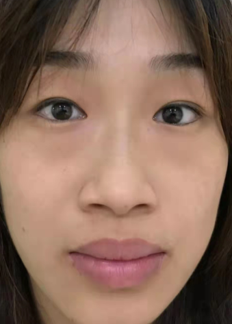 去眼袋手术