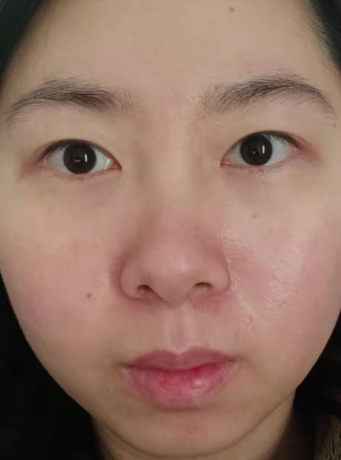 去眼袋手术