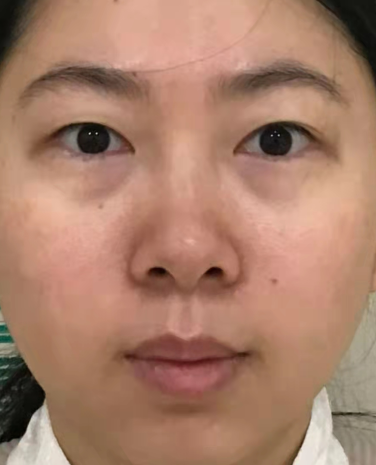 去眼袋手术