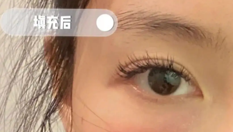 泪沟填充