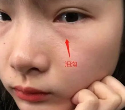 泪沟填充