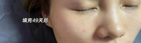 泪沟填充